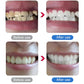 🦷✨Limpador Dental Ultrassônico Elétrico para Remoção de Tártaro e Placa